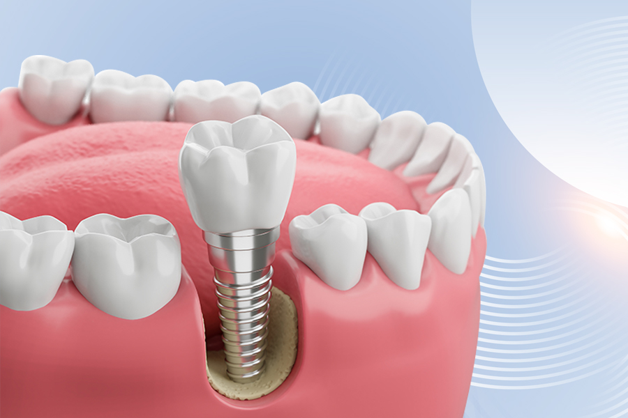 Dental Implants
